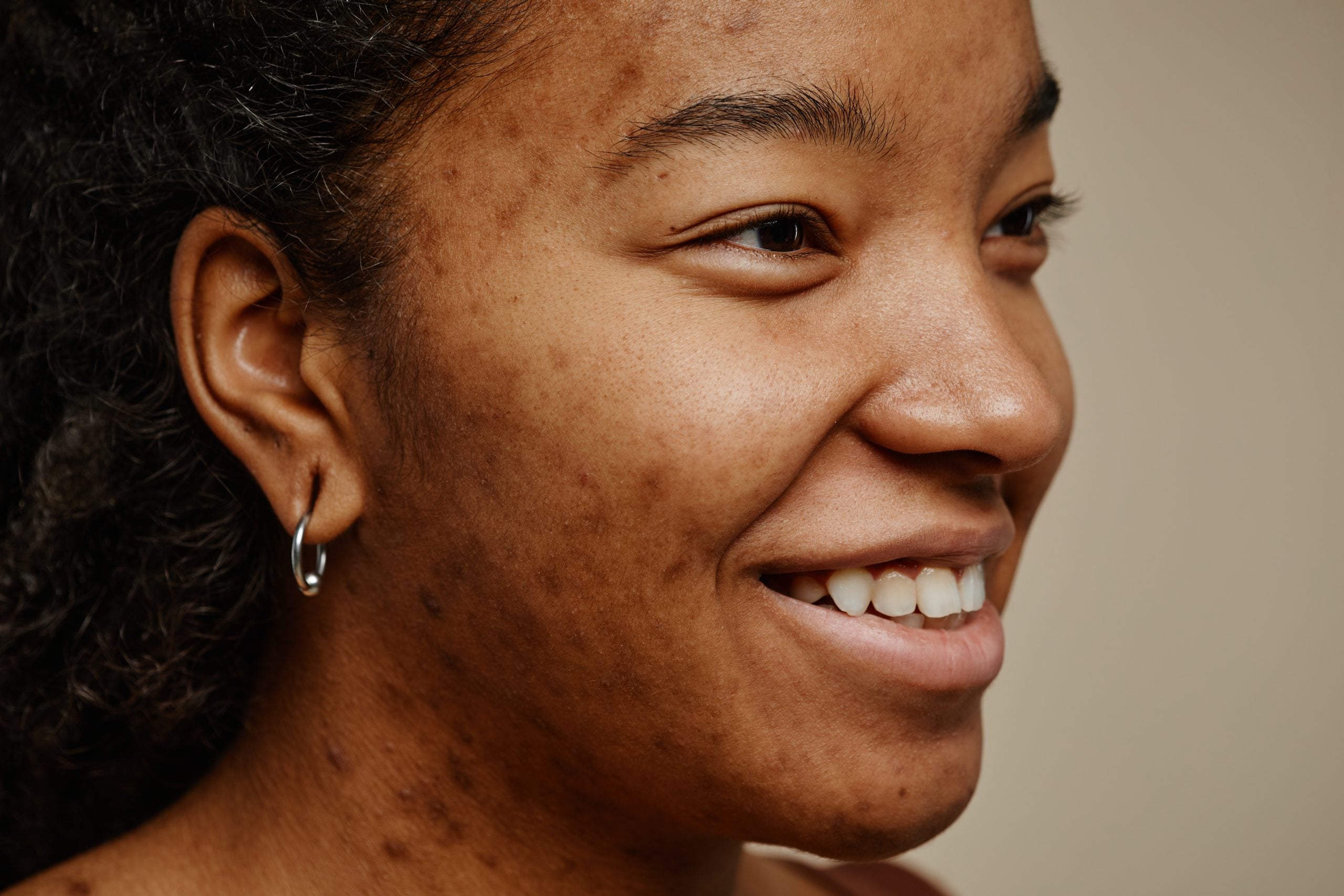 What Causes Discolouration from Acne Scars?