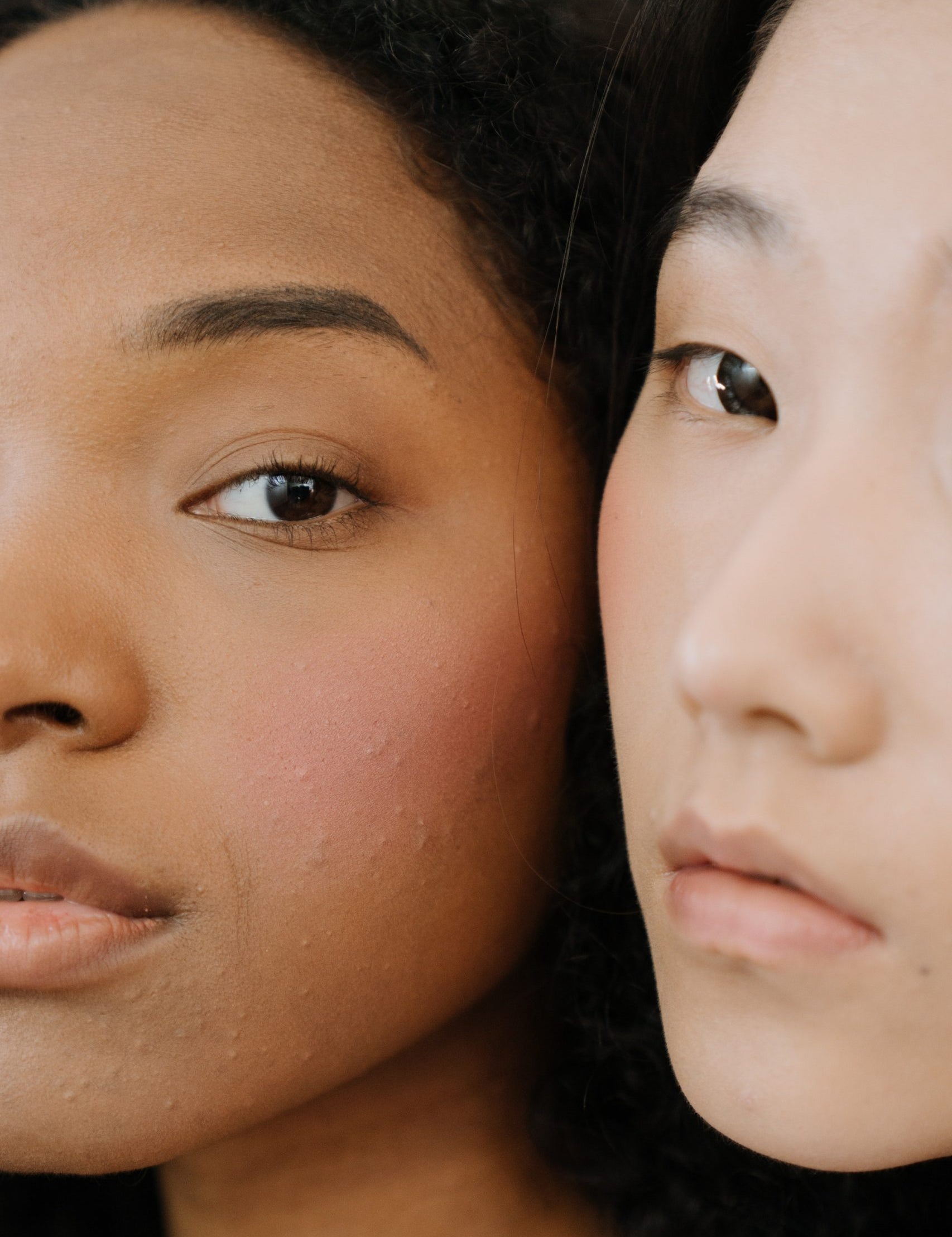 skin type 4 and 5 female acne