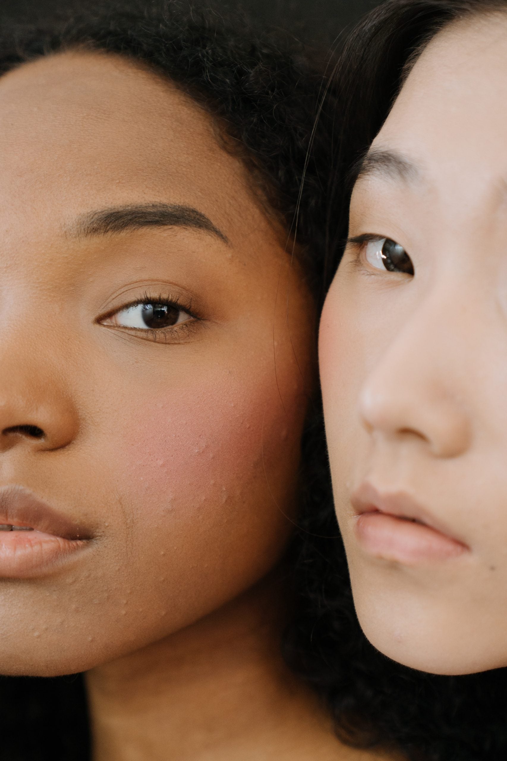skin type 4 and 5 female acne