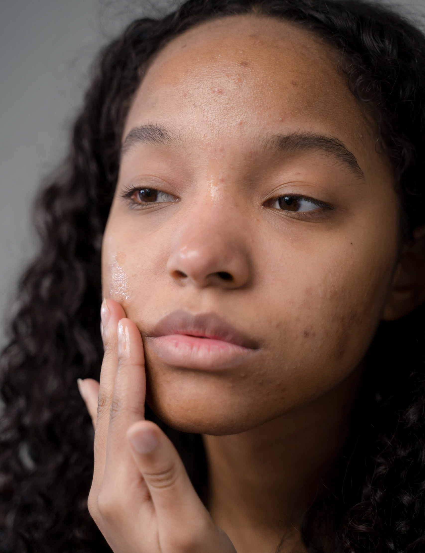 skin type 5 with acne