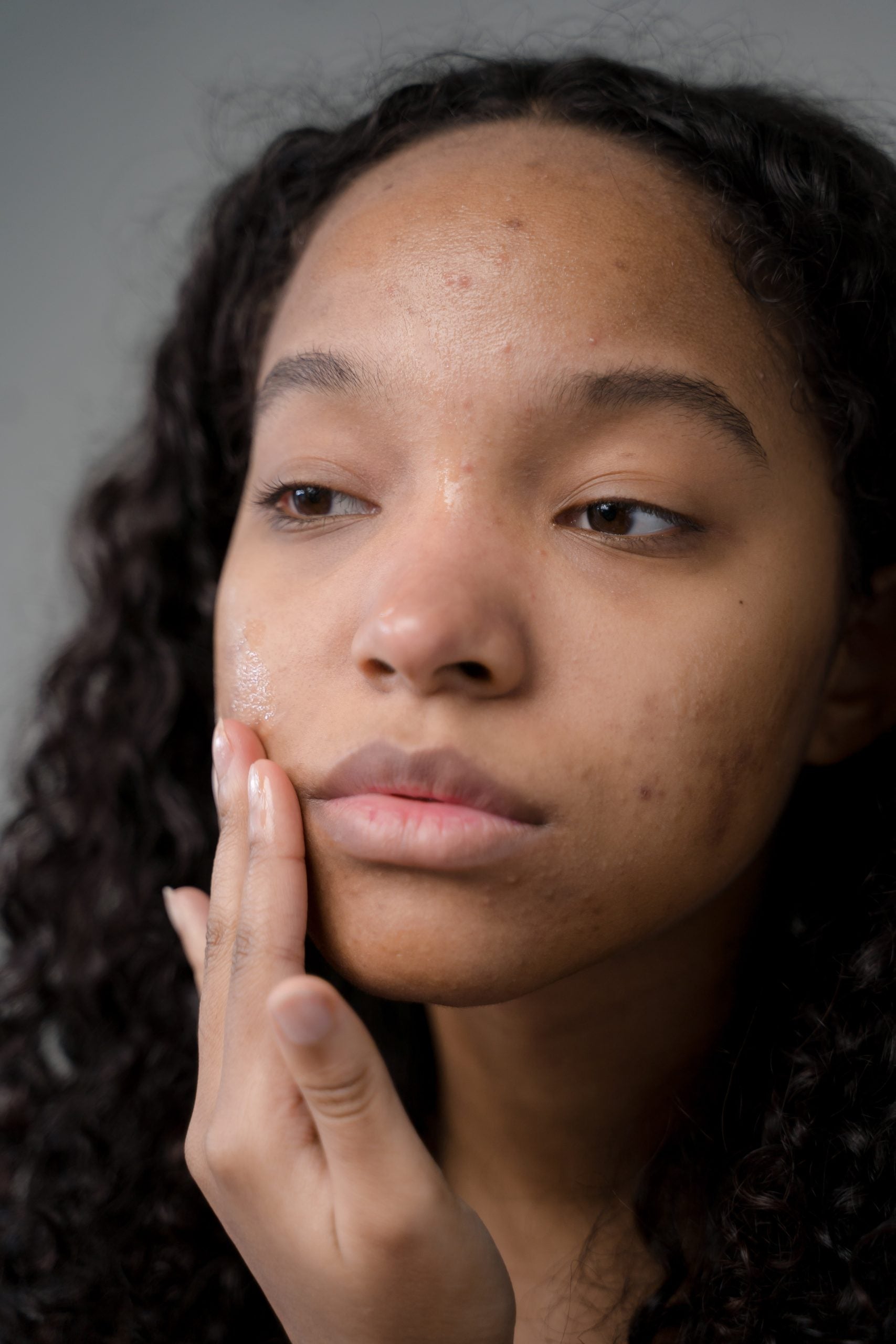 skin type 5 with acne