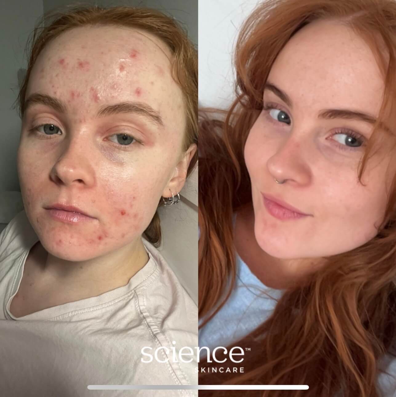 Science Skincare before and after results showing reduced acne breakouts and clearer skin in a lighter skin type