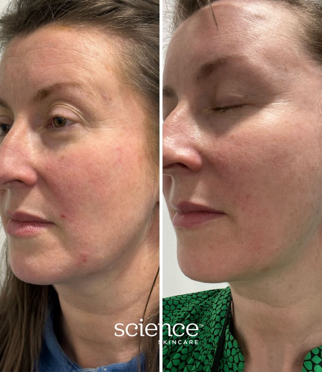 Science Skincare before and after transformation demonstrating soothed irritation, reduced inflammation and balanced complexion with Soothe + Calm system