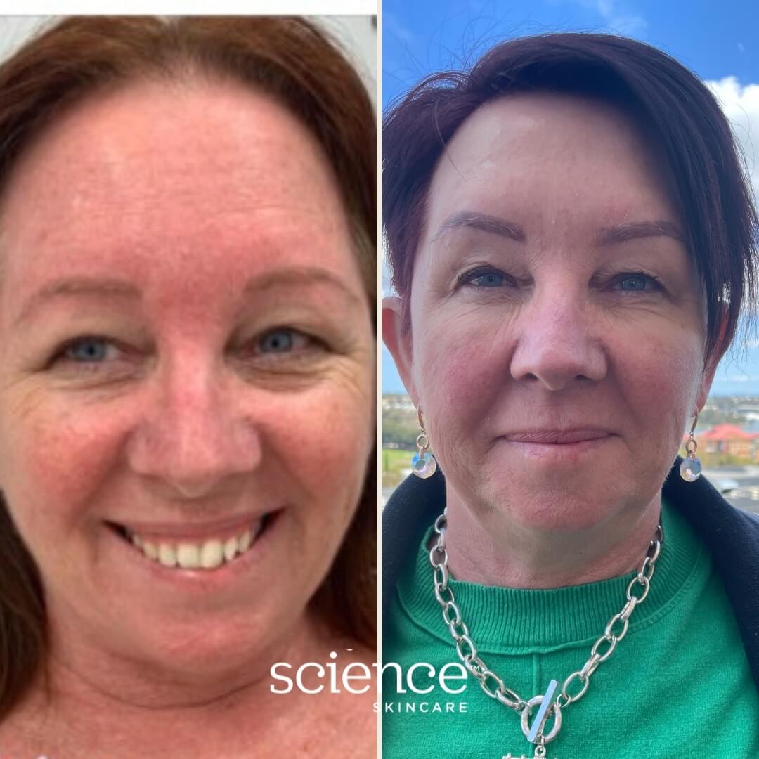 Soothe + Calm Collection before and after results showing reduced redness, calmer skin and improved barrier function for sensitive, reactive skin