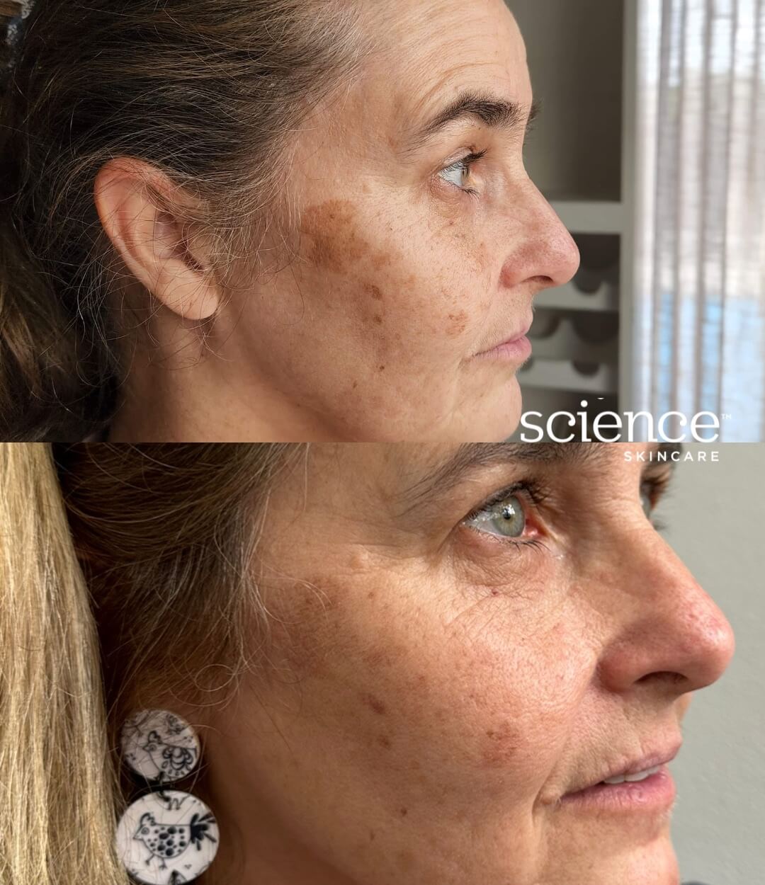 Science Skincare before and after results showing reduced pigmentation and improved skin texture