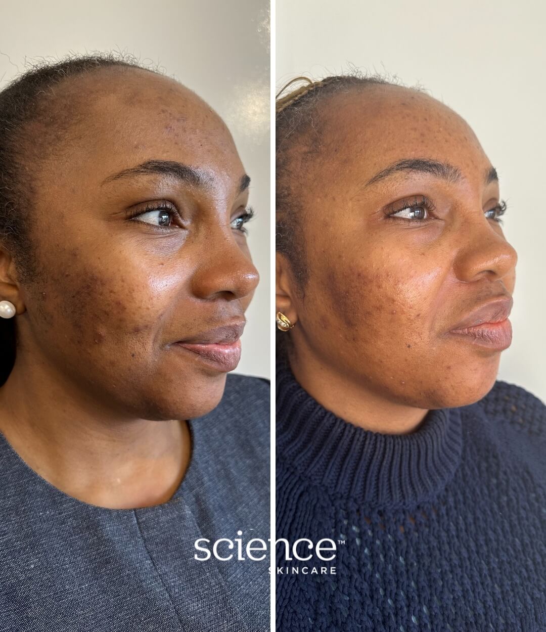 Breakout System before and after results showing faded acne scarring and balanced skin tone in a darker skin type