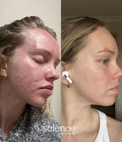 Acne treatment before and after transformation demonstrating reduced redness and improved skin texture
