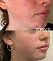 Teenage acne results with visibly clearer, calmer skin and reduced blemishes